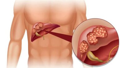 6 عاملی که باعث سرطان کبد میشوند بدون آنکه بفهمید!